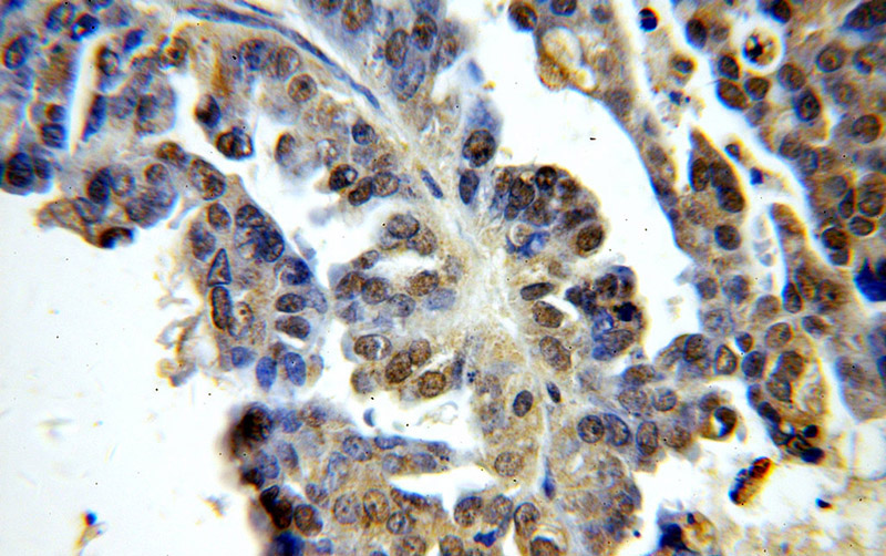 Immunohistochemical of paraffin-embedded human ovary tumor using Catalog No:111403(HIST1H1C antibody) at dilution of 1:100 (under 40x lens)