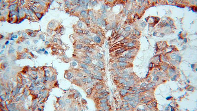 Immunohistochemical of paraffin-embedded human ovary tumor using Catalog No:108206(ERAP1 antibody) at dilution of 1:100 (under 40x lens)