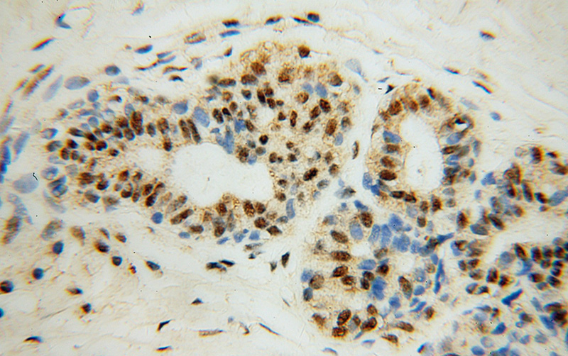 Immunohistochemical of paraffin-embedded human breast cancer using Catalog No:114043(POLR2H antibody) at dilution of 1:100 (under 40x lens)