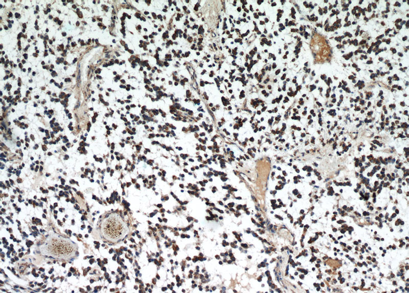Immunohistochemical of paraffin-embedded human gliomas using Catalog No:111601(IDH1 antibody) at dilution of 1:50 (under 10x lens)