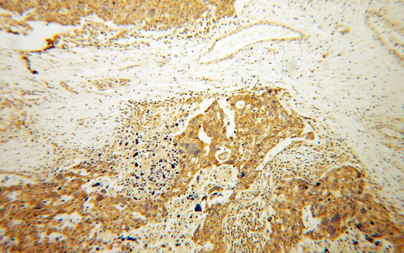 Immunohistochemical of paraffin-embedded human ovary tumor using Catalog No:108337(ATP11B antibody) at dilution of 1:100 (under 10x lens)
