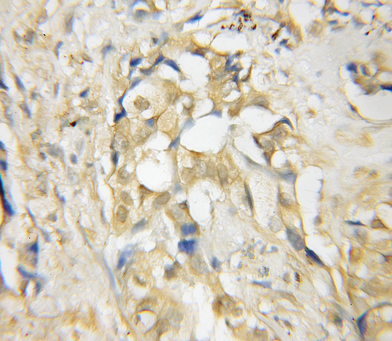 Immunohistochemical of paraffin-embedded human lung cancer using Catalog No:115913(TCN2 antibody) at dilution of 1:50 (under 10x lens)