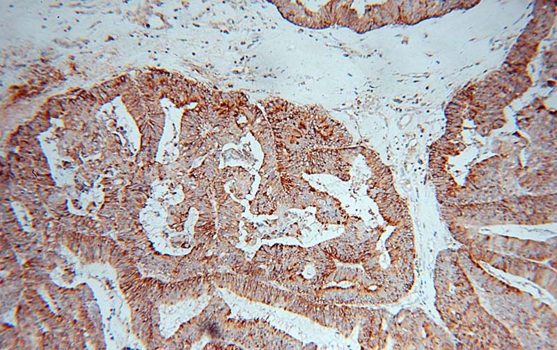 Immunohistochemical of paraffin-embedded human ovary tumor using Catalog No:108206(ERAP1 antibody) at dilution of 1:100 (under 10x lens)