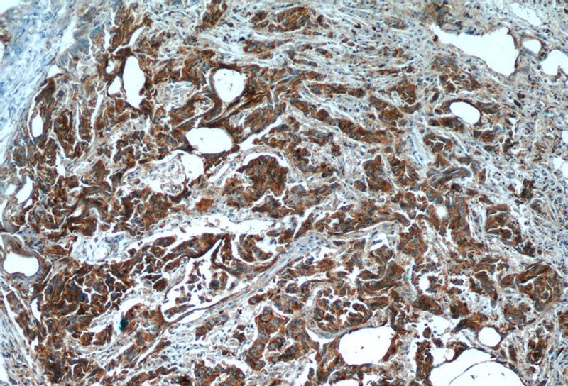 Immunohistochemistry of paraffin-embedded human prostate cancer tissue slide using Catalog No:110044(DocK4 Antibody) at dilution of 1:50 (under 10x lens)