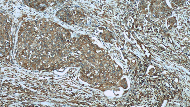 Immunohistochemical of paraffin-embedded human cervical cancer using Catalog No:110185(EIF2C1-Specific antibody) at dilution of 1:50 (under 10x lens)