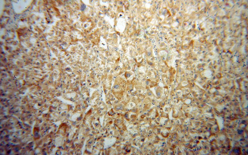 Immunohistochemical of paraffin-embedded human liver cancer using Catalog No:111341(HIBCH antibody) at dilution of 1:100 (under 10x lens)