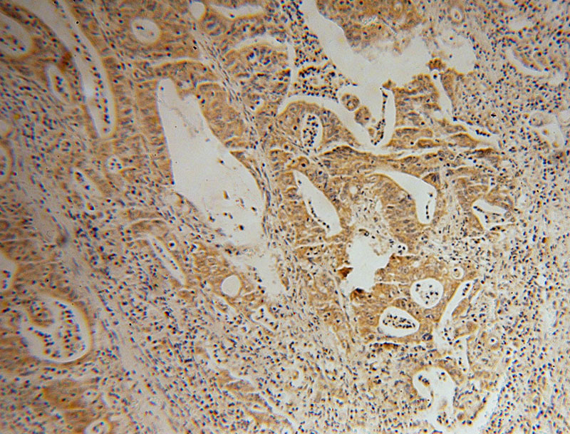 Immunohistochemical of paraffin-embedded human colon cancer using Catalog No:115681(STARD7 antibody) at dilution of 1:100 (under 10x lens)
