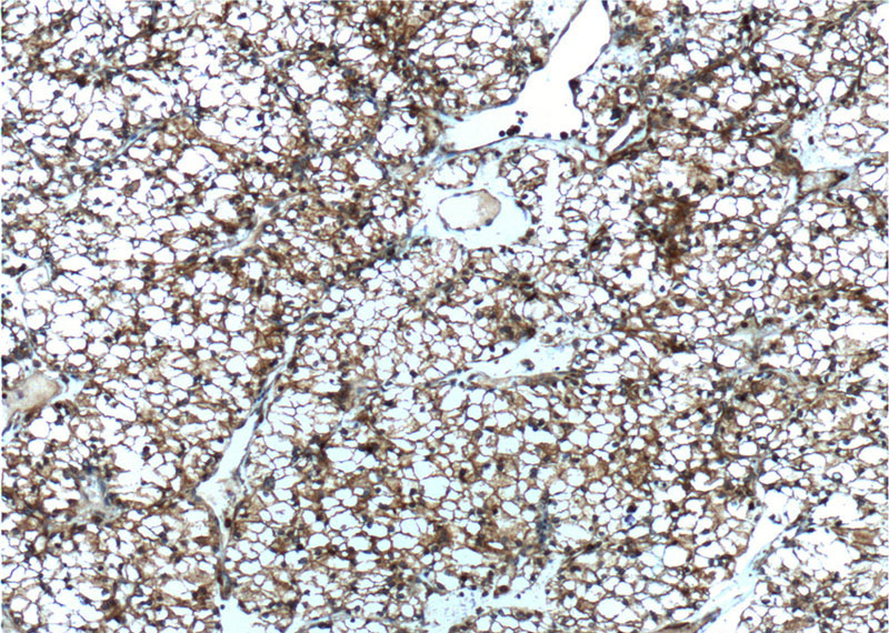 Immunohistochemistry of paraffin-embedded human renal cell carcinoma tissue slide using Catalog No:107524(SEPT2 Antibody) at dilution of 1:800 (under 10x lens). heat mediated antigen retrieved with Tris-EDTA buffer(pH9).