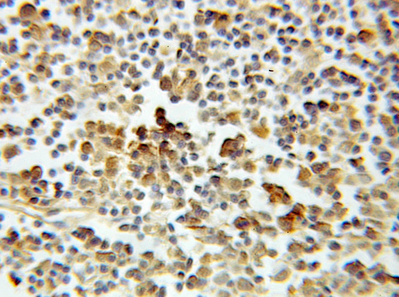 Immunohistochemical of paraffin-embedded human lymphoma using Catalog No:108222(ASF1A antibody) at dilution of 1:10 (under 10x lens)