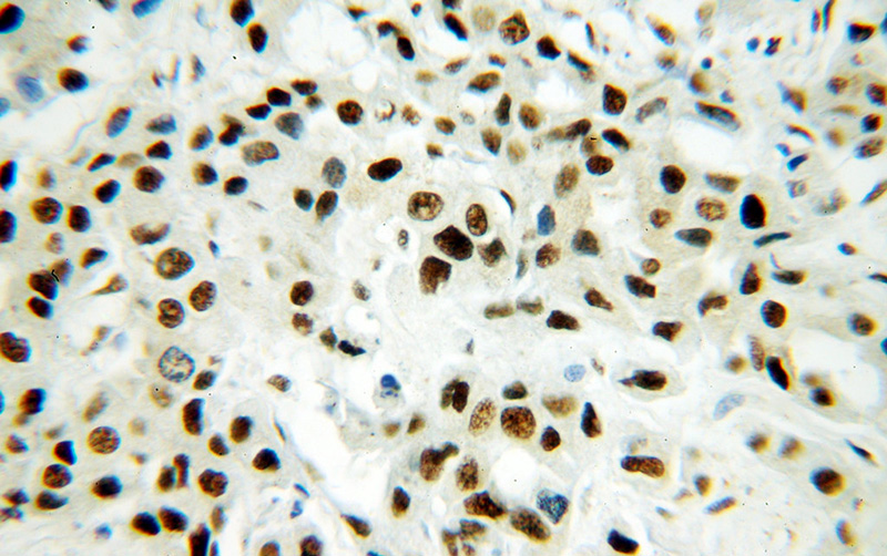 Immunohistochemical of paraffin-embedded human breast cancer using Catalog No:115133(SF3A1 antibody) at dilution of 1:400 (under 40x lens)