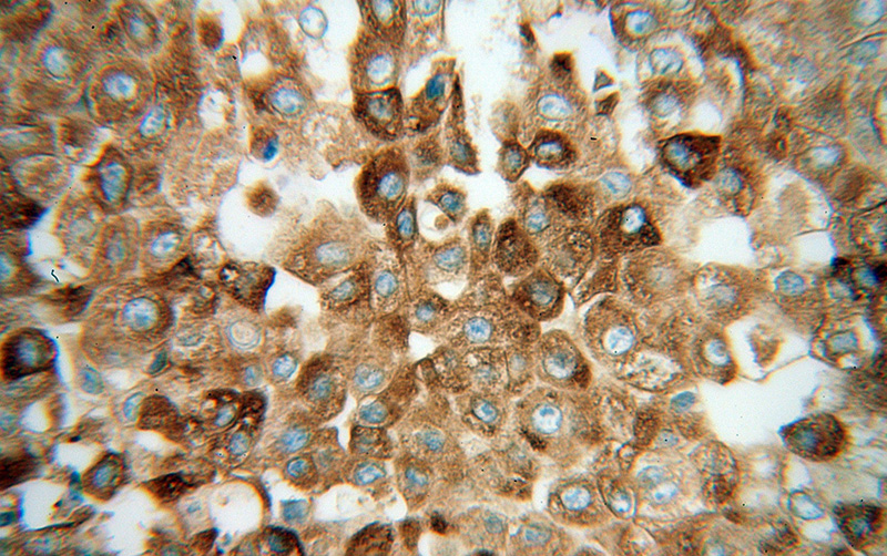 Immunohistochemical of paraffin-embedded human liver cancer using Catalog No:111151(GPX7 antibody) at dilution of 1:100 (under 40x lens)