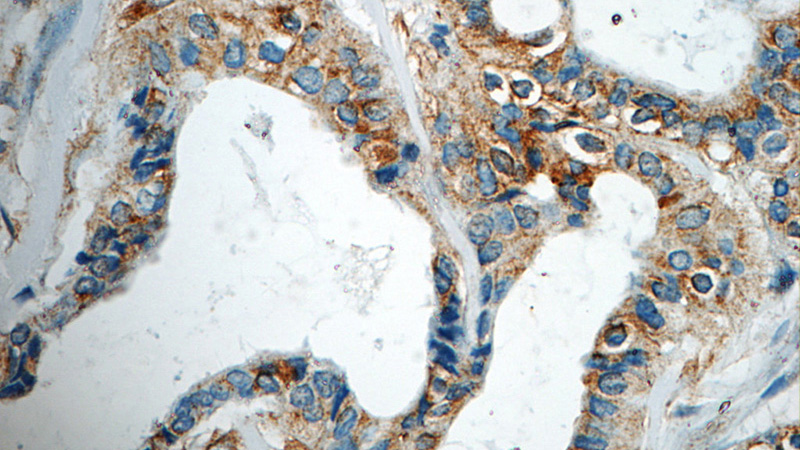 Immunohistochemistry of paraffin-embedded human breast cancer tissue slide using Catalog No:116608(USP34 Antibody) at dilution of 1:50 (under 40x lens)