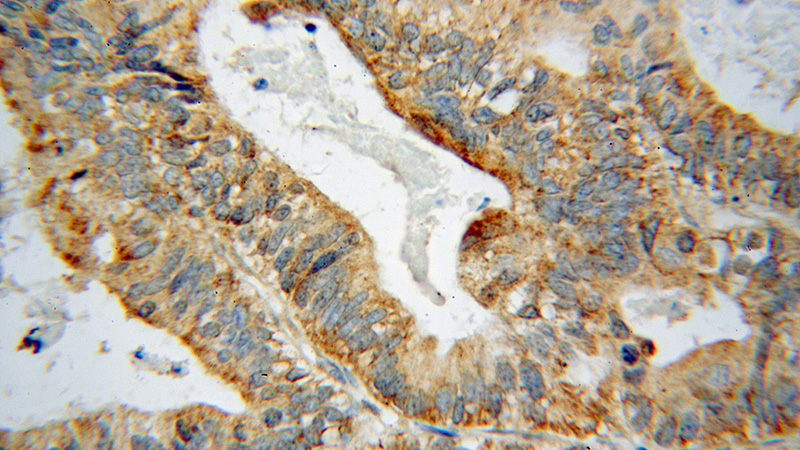 Immunohistochemical of paraffin-embedded human ovary tumor using Catalog No:111199(GRB14 antibody) at dilution of 1:50 (under 40x lens)