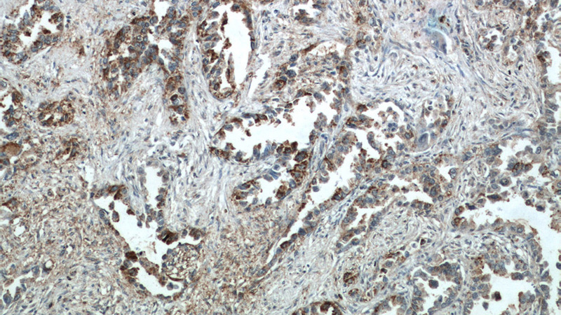 Immunohistochemical of paraffin-embedded human lung cancer using Catalog No:112071(KISS1 antibody) at dilution of 1:50 (under 10x lens)