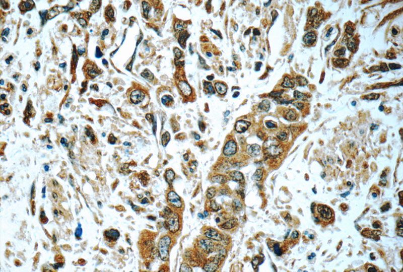 Immunohistochemistry of paraffin-embedded human stomach cancer tissue slide using Catalog No:108090(ANXA10 Antibody) at dilution of 1:100 (under 40x lens)