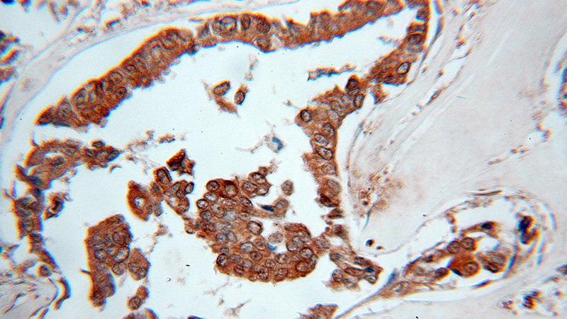 Immunohistochemical of paraffin-embedded human breast cancer using Catalog No:110508(EXOSC10 antibody) at dilution of 1:50 (under 40x lens)