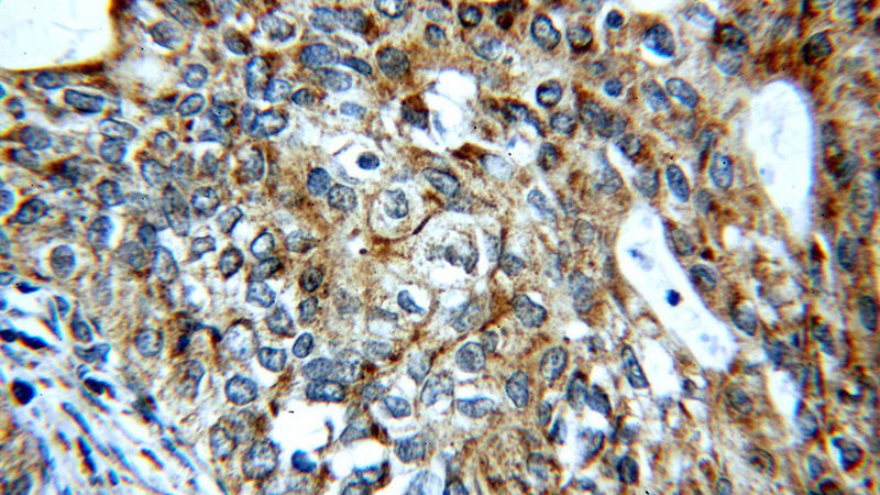Immunohistochemical of paraffin-embedded human cervical cancer using Catalog No:113870(PIK3CA antibody) at dilution of 1:50 (under 40x lens)