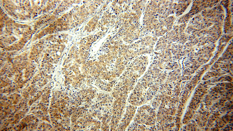 Immunohistochemical of paraffin-embedded human liver cancer using Catalog No:111570(HSP90 antibody) at dilution of 1:50 (under 10x lens)
