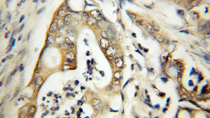 Immunohistochemical of paraffin-embedded human colon cancer using Catalog No:113448(NUSAP1 antibody) at dilution of 1:50 (under 10x lens)