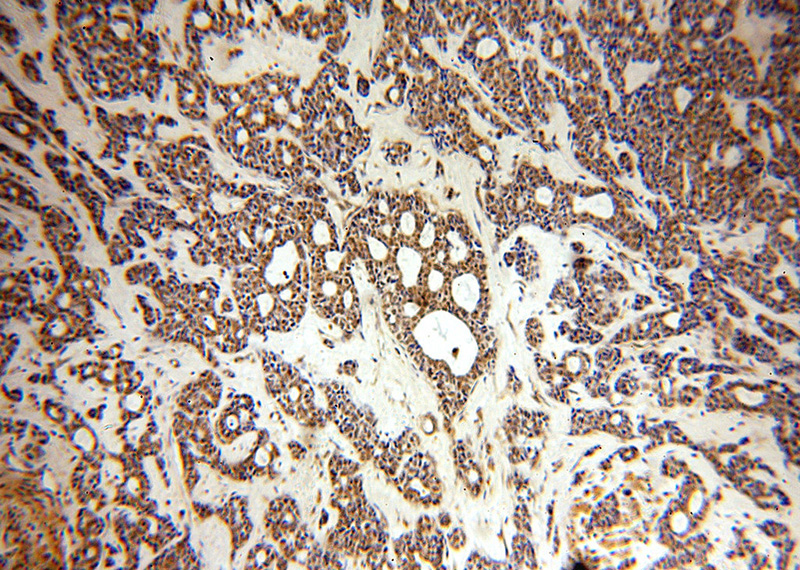 Immunohistochemical of paraffin-embedded human cervical cancer using Catalog No:115388(SMEK2 antibody) at dilution of 1:100 (under 10x lens)