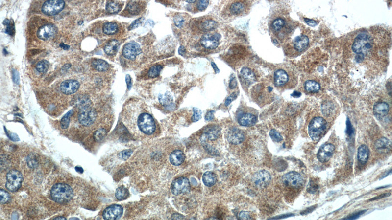 Immunohistochemistry of paraffin-embedded human liver cancer tissue slide using Catalog No:115207(SERPIND1 Antibody) at dilution of 1:50 (under 40x lens)