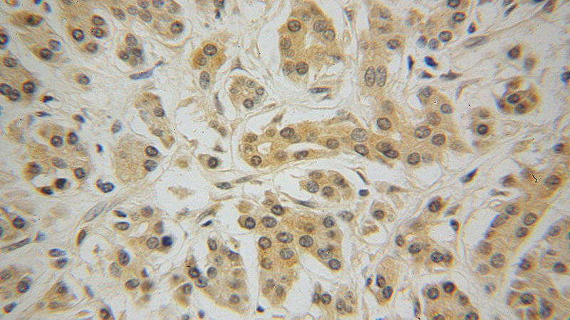 Immunohistochemical of paraffin-embedded human pancreas cancer using Catalog No:113492(SERPINE1 antibody) at dilution of 1:50 (under 40x lens)