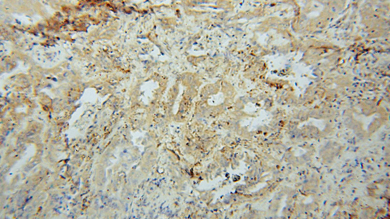 Immunohistochemical of paraffin-embedded human lung cancer using Catalog No:114171(PRCP antibody) at dilution of 1:50 (under 10x lens)