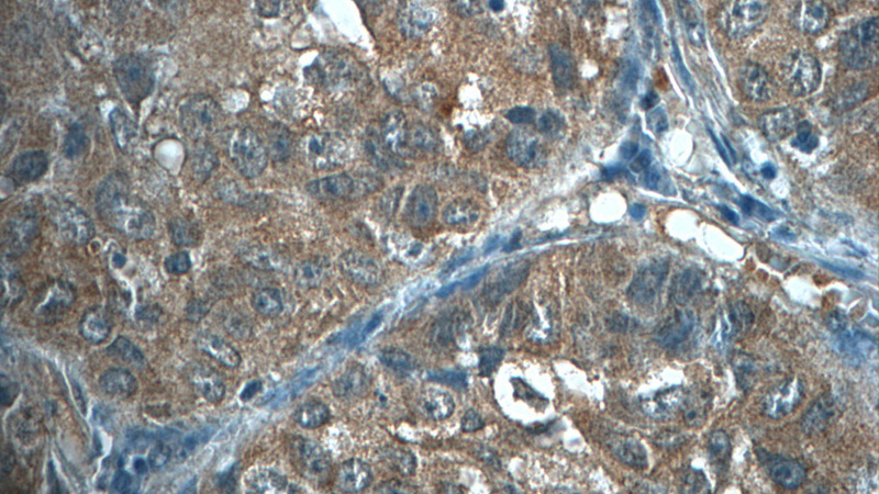 Immunohistochemistry of paraffin-embedded human lung cancer tissue slide using Catalog No:114285(PRX3 Antibody) at dilution of 1:50 (under 40x lens)