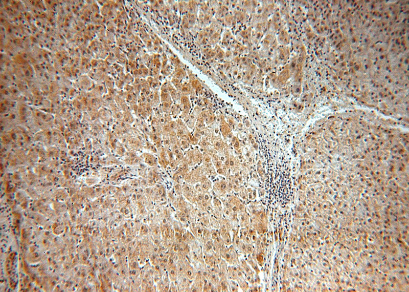 Immunohistochemical of paraffin-embedded human liver cancer using Catalog No:117193(BMI1 antibody) at dilution of 1:50 (under 10x lens)