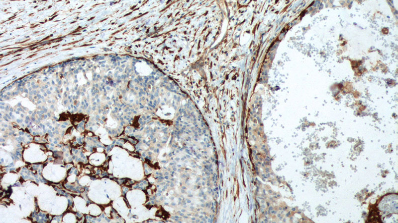 Immunohistochemistry of paraffin-embedded human breast hyperplasia tissue slide using Catalog No:107166(CNN2 Antibody) at dilution of 1:2000 (under 10x lens). heat mediated antigen retrieved with Tris-EDTA buffer(pH9).