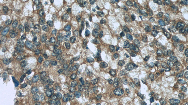 Immunohistochemistry of paraffin-embedded human prostate cancer tissue slide using Catalog No:115799(STX6 Antibody) at dilution of 1:50 (under 40x lens)