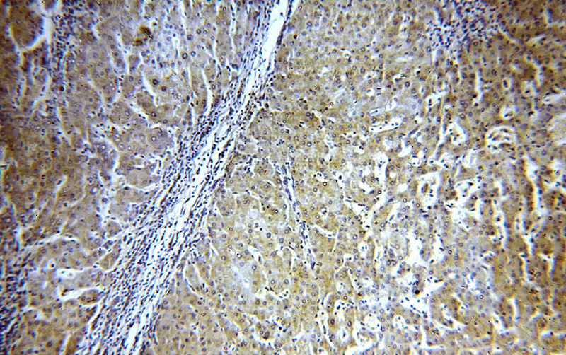Immunohistochemical of paraffin-embedded human hepatocirrhosis using Catalog No:107957(AOX1 antibody) at dilution of 1:100 (under 10x lens)