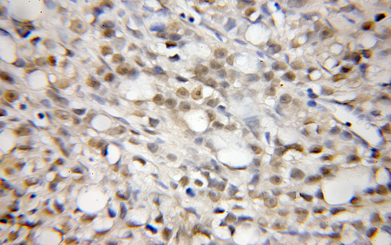 Immunohistochemical of paraffin-embedded human prostate cancer using Catalog No:109554(CREM antibody) at dilution of 1:50 (under 10x lens)