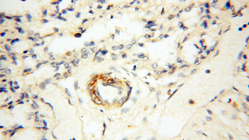 Immunohistochemical of paraffin-embedded human lung using Catalog No:117211(BOLA1 antibody) at dilution of 1:100 (under 40x lens)