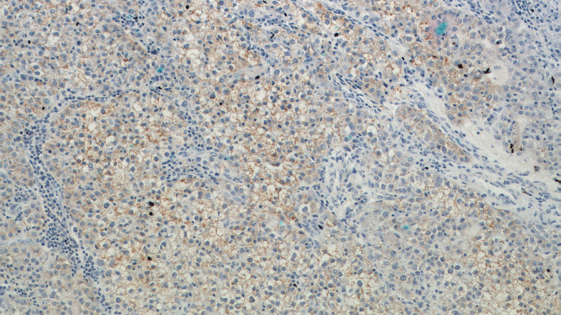 Immunohistochemical of paraffin-embedded human liver cancer using Catalog No:110025(DSE antibody) at dilution of 1:50 (under 10x lens)
