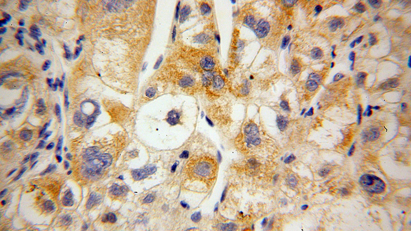 Immunohistochemical of paraffin-embedded human liver cancer using Catalog No:112629(MIPOL1 antibody) at dilution of 1:100 (under 40x lens)
