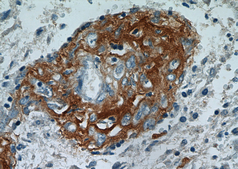 Immunohistochemical of paraffin-embedded human gliomas using Catalog No:108280(ATXN2 antibody) at dilution of 1:50 (under 40x lens)