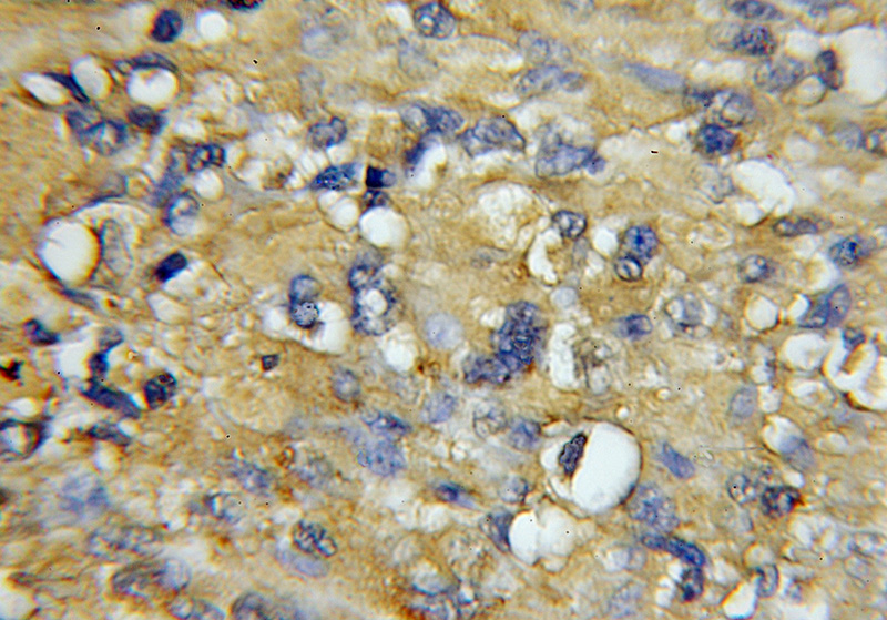 Immunohistochemical of paraffin-embedded human gliomas using Catalog No:109497(COX7A1 antibody) at dilution of 1:100 (under 10x lens)