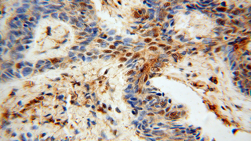 Immunohistochemical of paraffin-embedded human skin cancer using Catalog No:110866(GAR1 antibody) at dilution of 1:50 (under 40x lens)