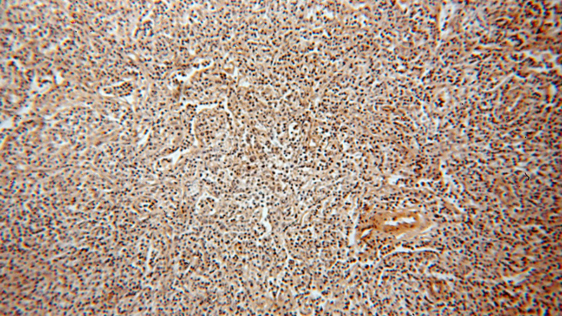 Immunohistochemical of paraffin-embedded human lymphoma using Catalog No:116505(TXK antibody) at dilution of 1:100 (under 10x lens)
