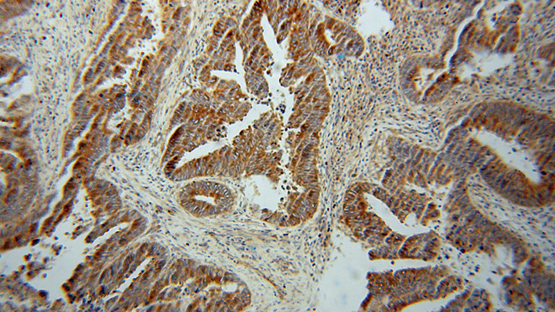 Immunohistochemical of paraffin-embedded human colon cancer using Catalog No:114827(RPS12 antibody) at dilution of 1:50 (under 10x lens)