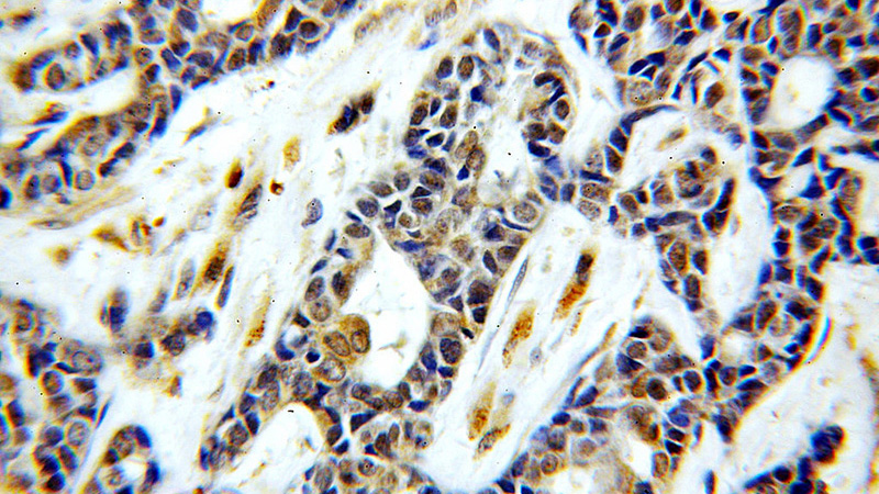 Immunohistochemical of paraffin-embedded human cervical cancer using Catalog No:108274(C12orf11 antibody) at dilution of 1:100 (under 40x lens)