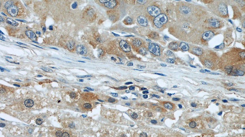 Immunohistochemical of paraffin-embedded human liver cancer using Catalog No:107054(AGT antibody) at dilution of 1:50 (under 40x lens)
