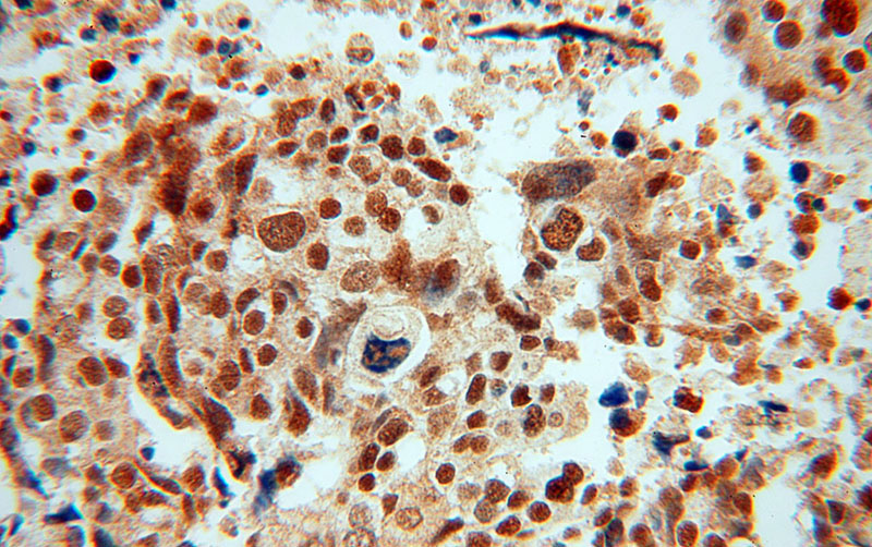 Immunohistochemical of paraffin-embedded human ovary tumor using Catalog No:115610(SSRP1 antibody) at dilution of 1:100 (under 40x lens)