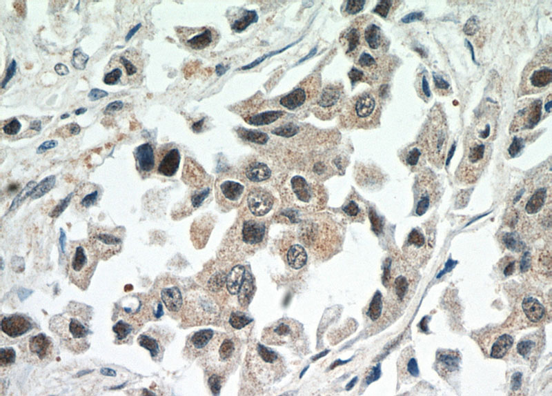 Immunohistochemical of paraffin-embedded human breast cancer using Catalog No:108901(CBLL1 antibody) at dilution of 1:50 (under 40x lens)