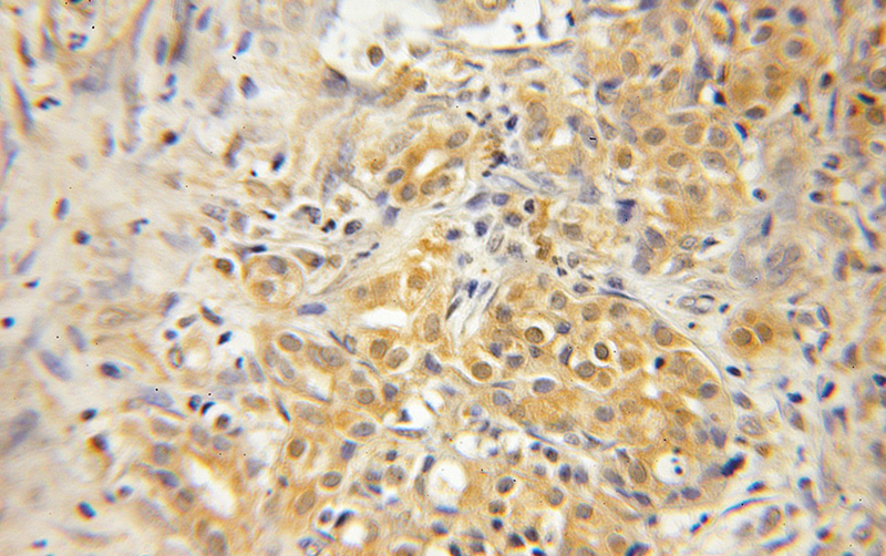 Immunohistochemical of paraffin-embedded human pancreas cancer using Catalog No:111008(GNPDA1 antibody) at dilution of 1:50 (under 10x lens)