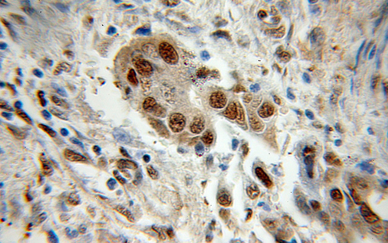 Immunohistochemical of paraffin-embedded human colon cancer using Catalog No:114372(PSMA1 antibody) at dilution of 1:50 (under 10x lens)