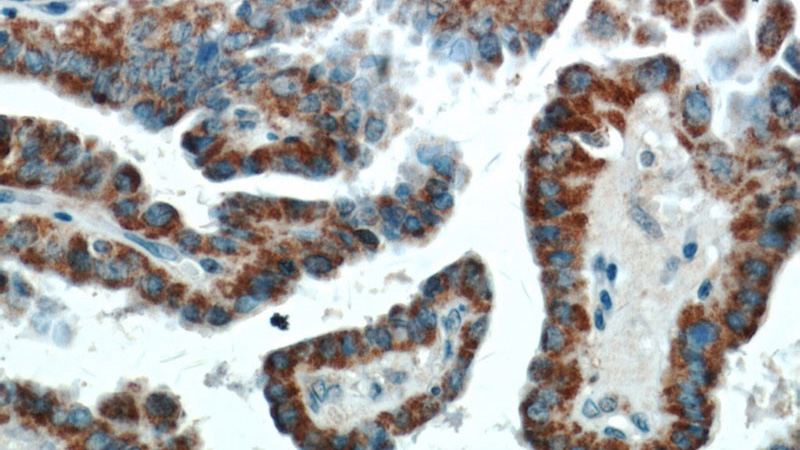 Immunohistochemical of paraffin-embedded human thyroid cancer using Catalog No:110294(ECM1 antibody) at dilution of 1:100 (under 40x lens)