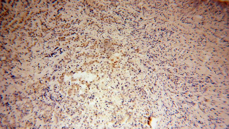 Immunohistochemical of paraffin-embedded human prostate cancer using Catalog No:109873(DAZAP1 antibody) at dilution of 1:100 (under 10x lens)