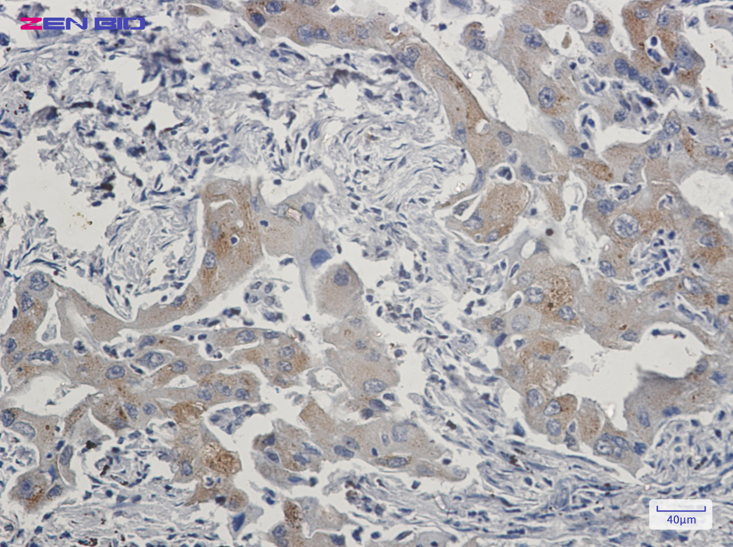 Immunohistochemistry of TRAF6BP in paraffin-embedded Human lung cancer tissue using TRAF6BP Rabbit pAb at dilution 1/20